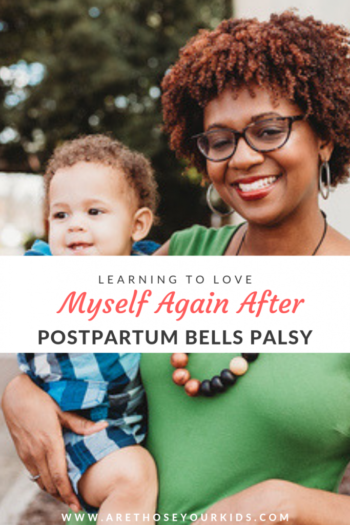 Having postpartum bells palsy is a scary experience--especially because you have no idea how long it will last and if the effects are permanant. 